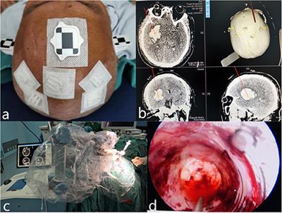 Effect of Robot-Assisted Neuroendoscopic Hematoma Evacuation Combined Intracranial Pressure Monitoring for the Treatment of Hypertensive Intracerebral Hemorrhage